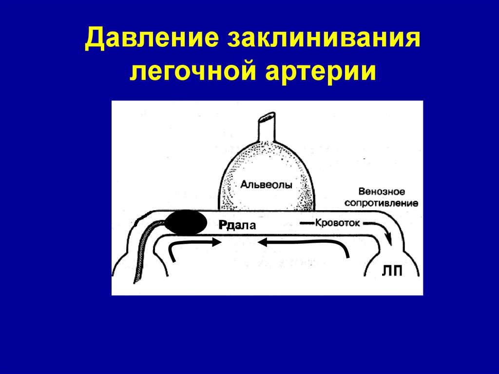 Давление в легочной артерии. Давление заклинивания легочной артерии. Давление заклинивания. Давление заклинивания легочной артерии норма. Заклинивания легочных капилляров.