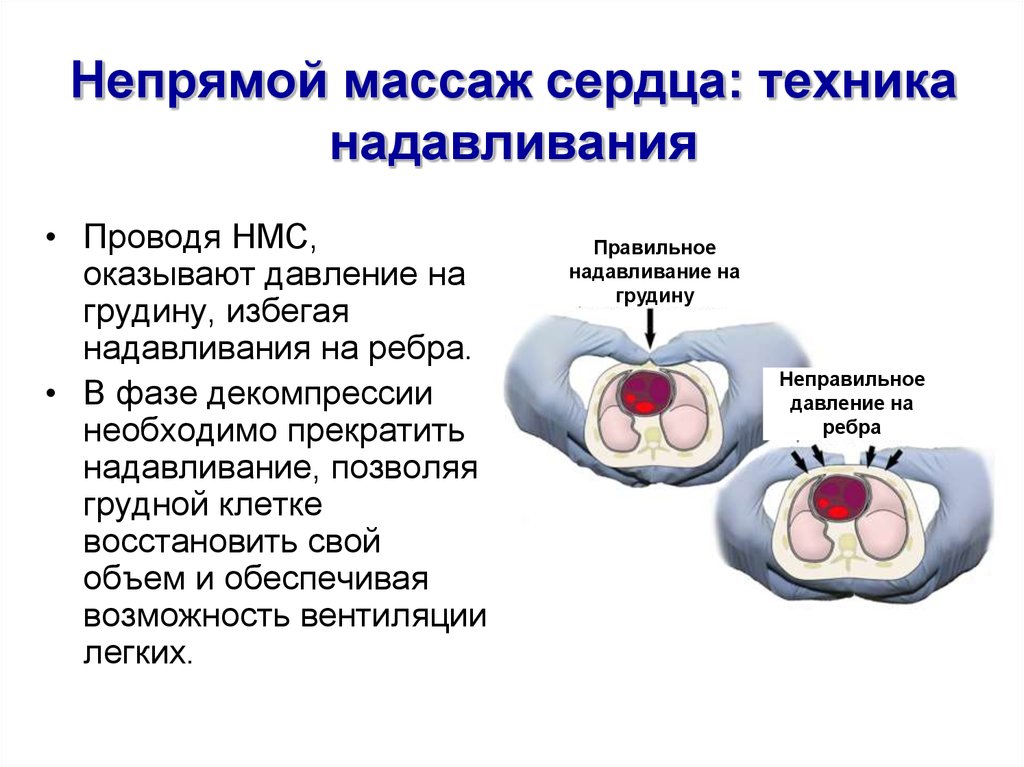 Непрямой массаж сердца количество надавливаний. Непрямой массаж сердца техника. Давление на грудную клетку при НМС. Механизм непрямого массажа сердца. Непрямой массаж сердца 30 к 2 или 15 к 2.