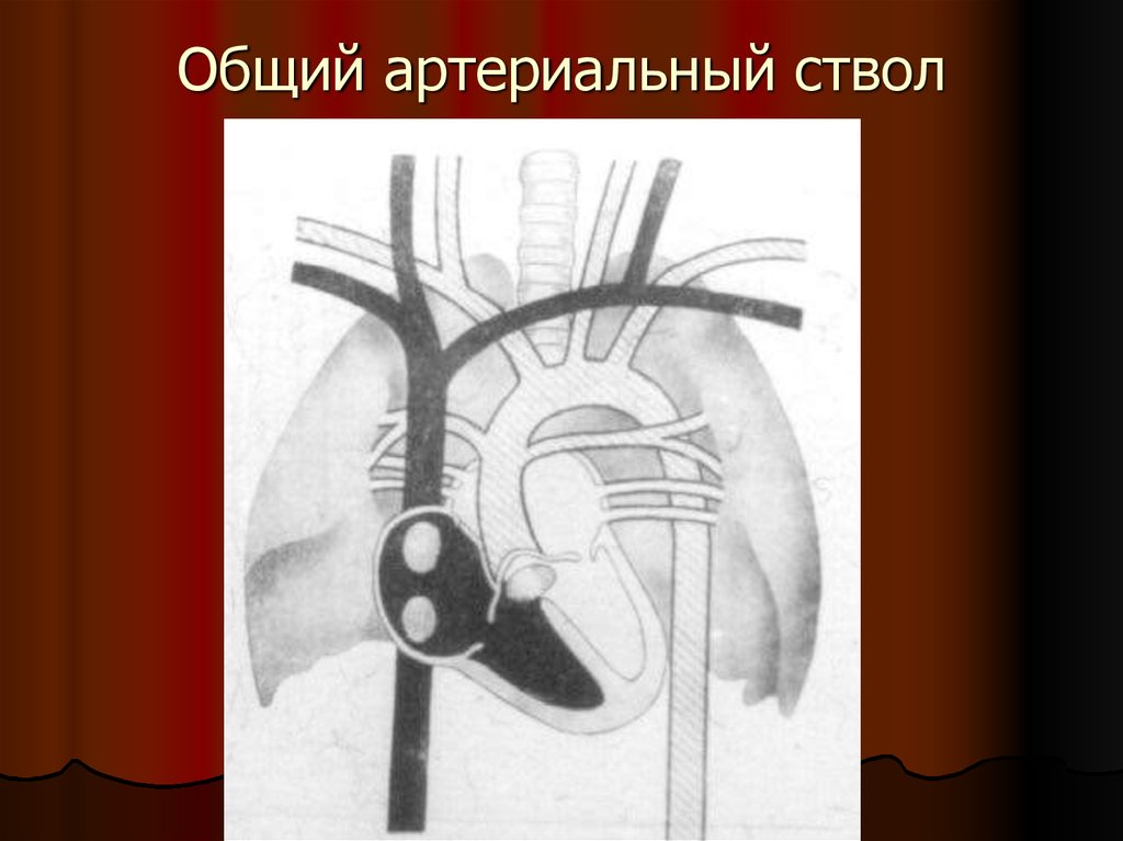 Общий артериальный ствол презентация