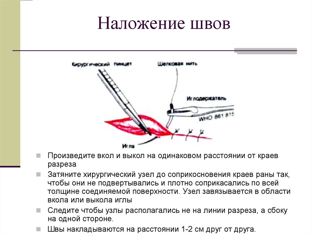 Сколько держат швы. Наложение и снятие хирургических швов алгоритм. Наложить узловые кожные швы на рану. Наложение кожных швов алгоритм. Хирургических узлов наложении швов..