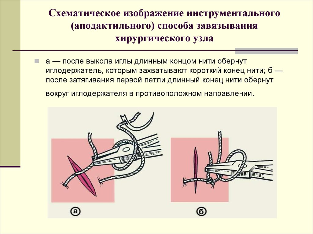 Схематическое изображение инструментального (аподактильного) способа завязывания хирургического узла