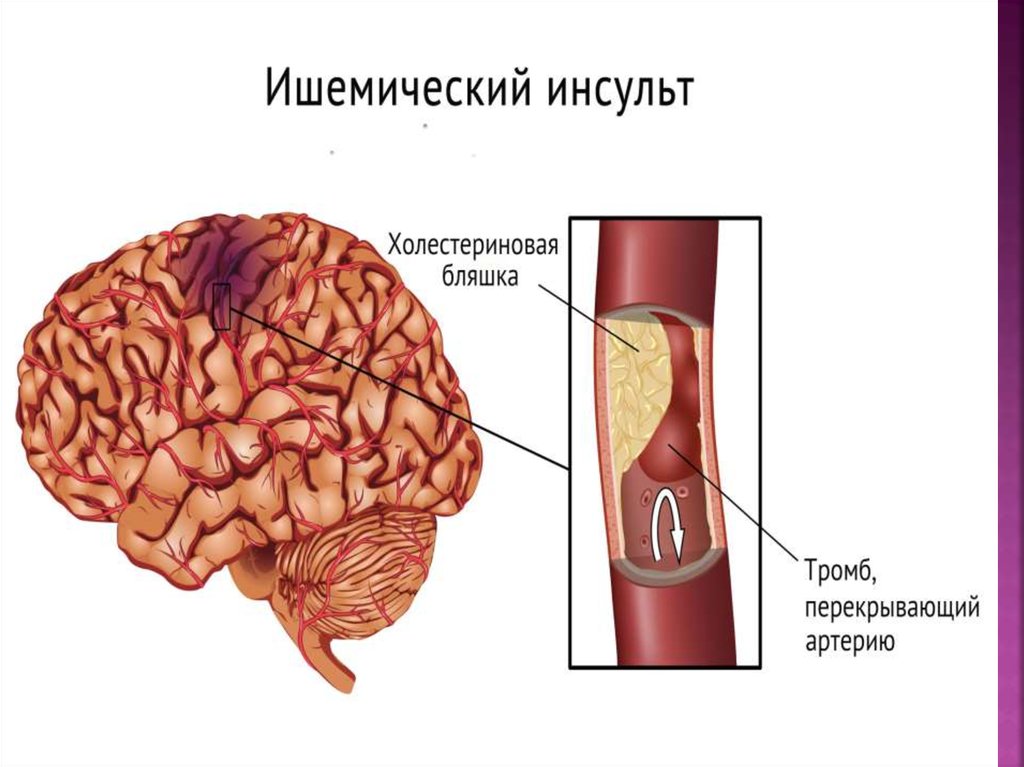 Инсульт головы. Ишемический инсульт головного мозга. ОНМК ишемический инсульт. Ишемический инсульт морфология. Атеросклероз артерий головного мозга макропрепарат.