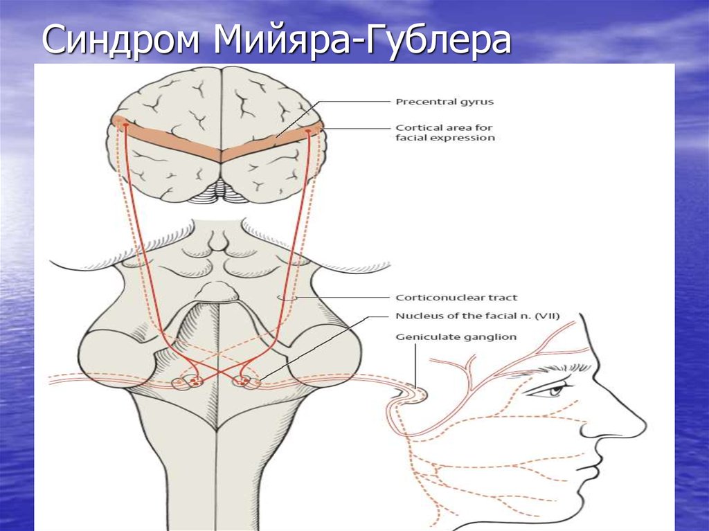 Синдром мийяра гюблера