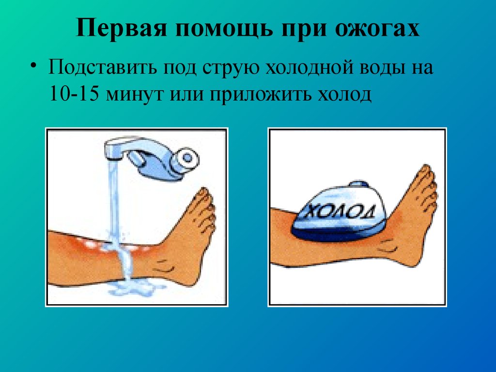 Оказание помощи при ожогах. Первая помощь при ожогах. Ожоги первая помощь при ожогах. Схема действий при ожогах. Оказание первой помощи при ожоге кипятком.