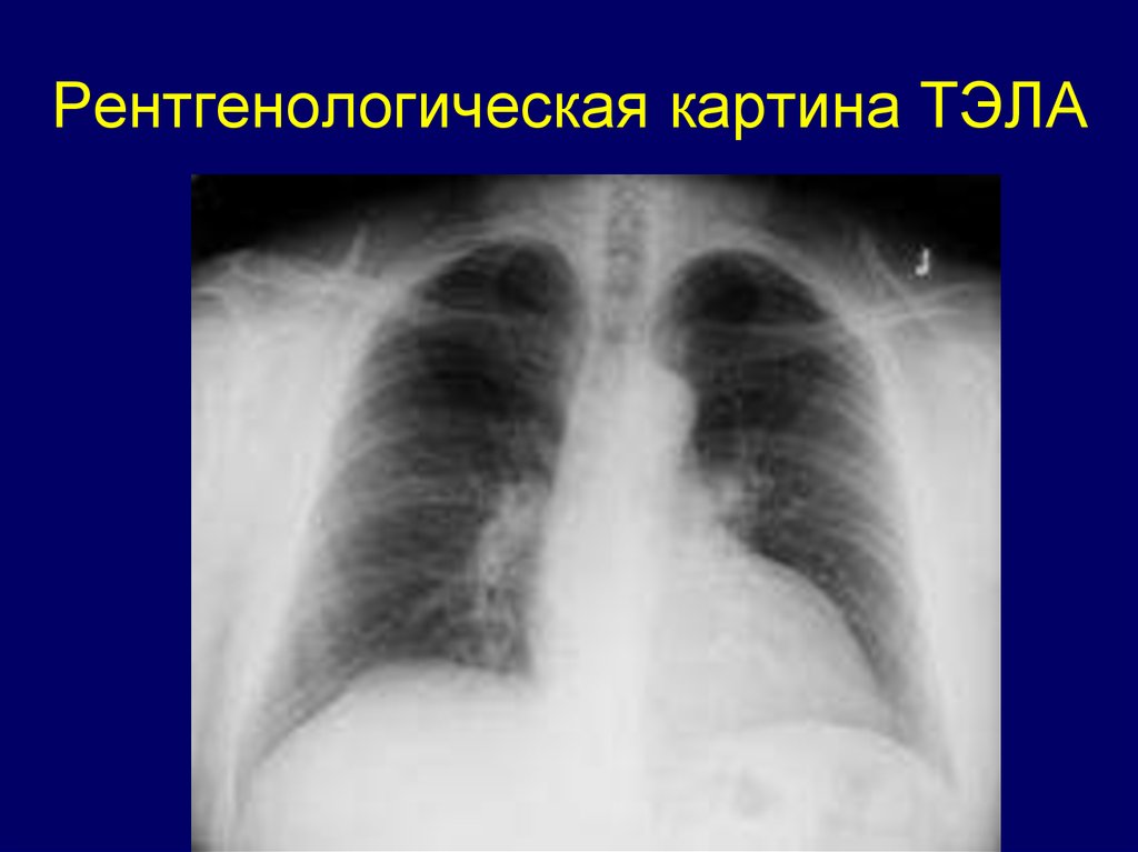 Тромбоэмболия легочной артерии пневмония. Эмболия легочной артерии рентген. Инфаркт легкого при Тэла рентген. Тромбоэмболия легочной артерии рентген. Рентгенография легких при Тэла.