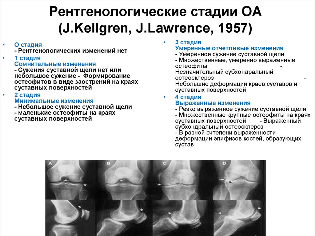 Диагноз доа суставов. Рентген стадии остеоартроза. Классификация артроза коленного сустава рентген. Классификация рентгенологических стадий остеоартроза. Рентгенологические стадии остеоартроза (по a. Larsen, 1987):.