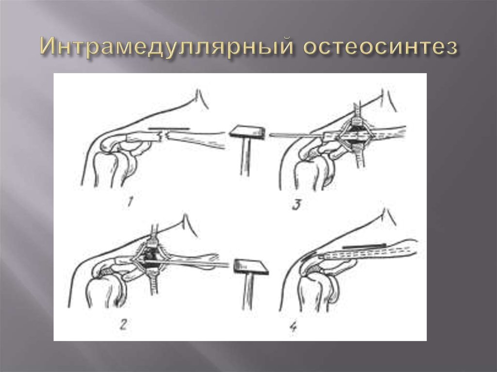 Остеосинтез локтевого отростка по веберу