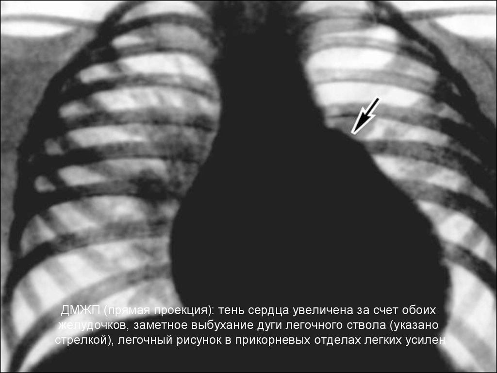 Тень сердца расширена. Дефект межжелудочковой перегородки рентген. Дефект межжелудочковой перегородки на рентгенограмме. Рентген при дефекте межжелудочковой перегородки.