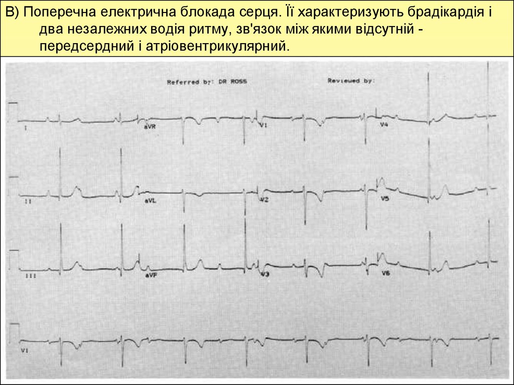 Блокада сердца. АВ блокада 2 ст Мобитц 1 и 2. Поперечная блокада 1 степени на ЭКГ. Блокады сердца на ЭКГ классификация. Синусная блокада сердца.