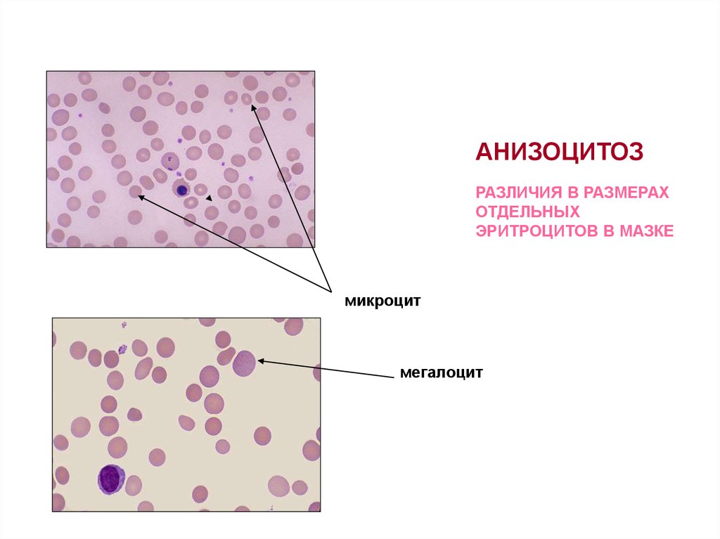 Эритроциты в мазке. Анизоцитоз мегалоциты. Анизоцитоз в мазке крови. Анизоцитоз мазок крови. Анизоцитоз в мазке.