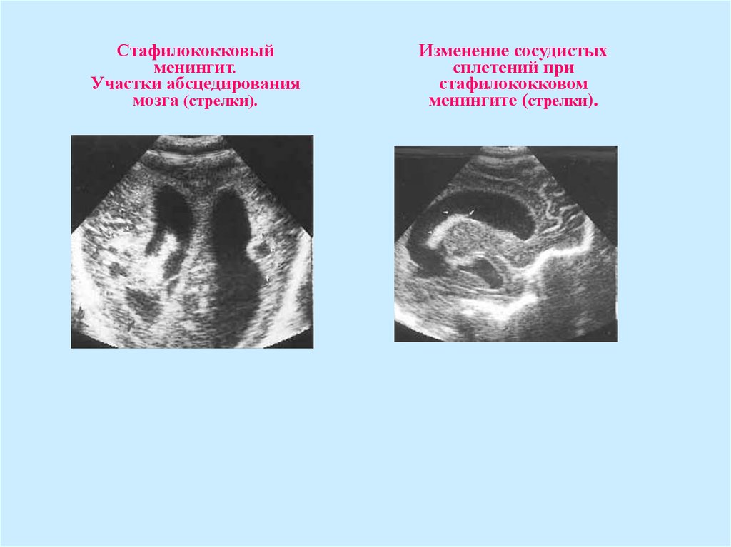 Менингит презентация казакша