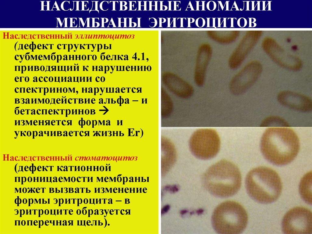 Эллиптоцитоз. Наследственные дефекты мембраны эритроцитов приводят к. Наследственный эллиптоцитоз. Наследственные дефекты мембраны эритроцитов приводя. Гемолитическая анемия овалоцитоз.