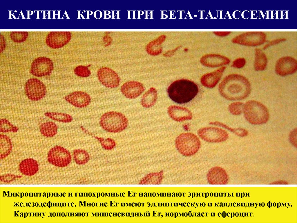 Гемолитическая анемия картина крови