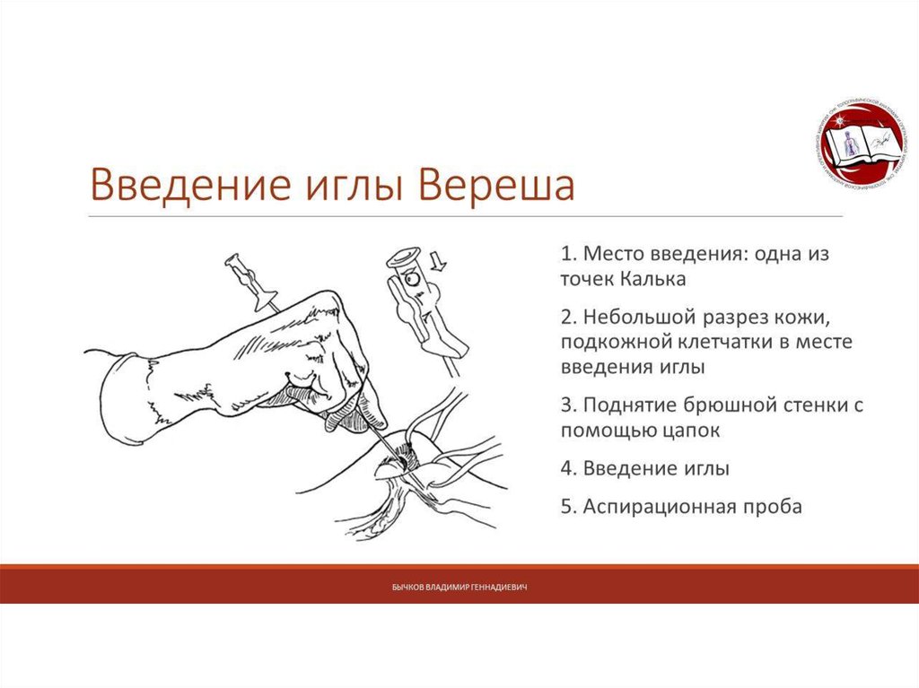 Введение просто. Техника введения иглы Вереша. Игла Вереша место введения. Введение иглы Вереша в брюшную полость. Точки Введение иглы Вереша точка.