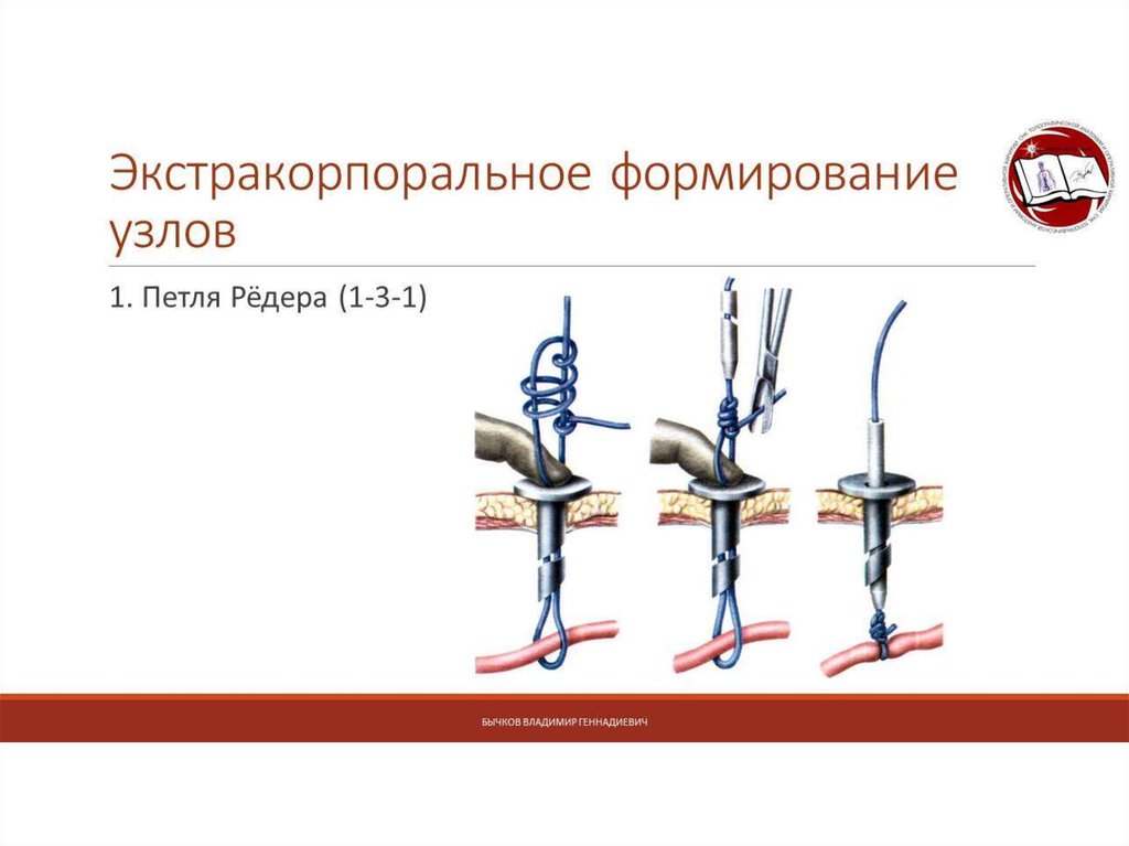 Формирование узлов. Экстракорпоральный шов. Узел Редера. Экстракорпоральное формирование узлов. Петля Редера для лапароскопии.