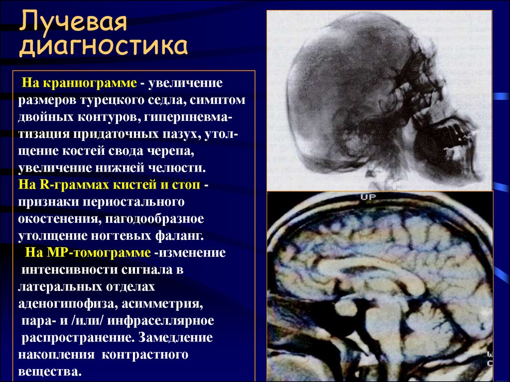 Лучевой диагноз. Симптом двойного контура. Увеличенное турецкое седло. Симптом турецкого седла. На краниограмме увеличение турецкого седла.