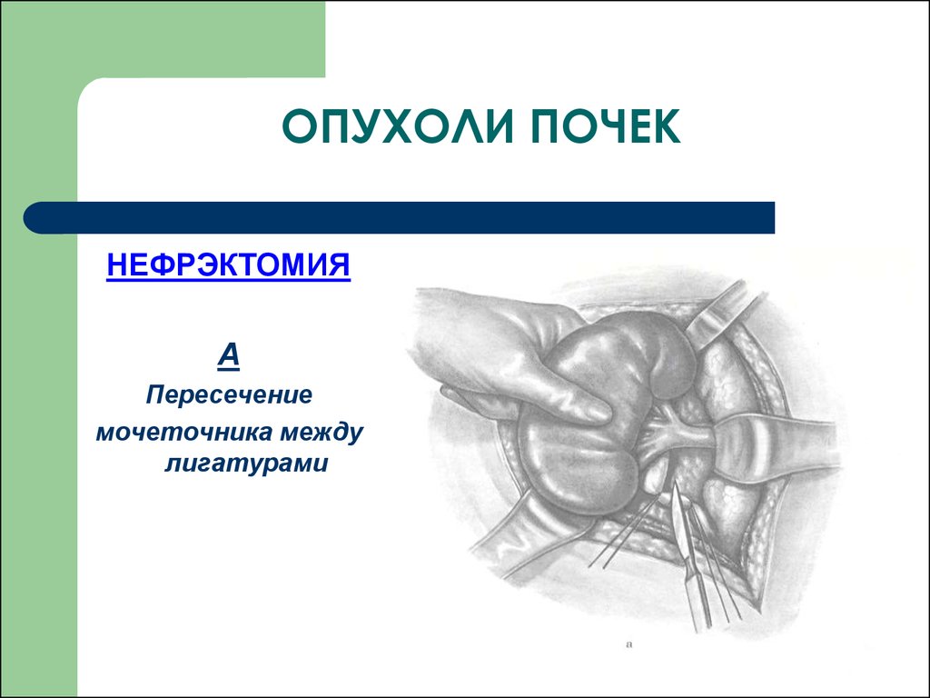 Опухоли почек презентация