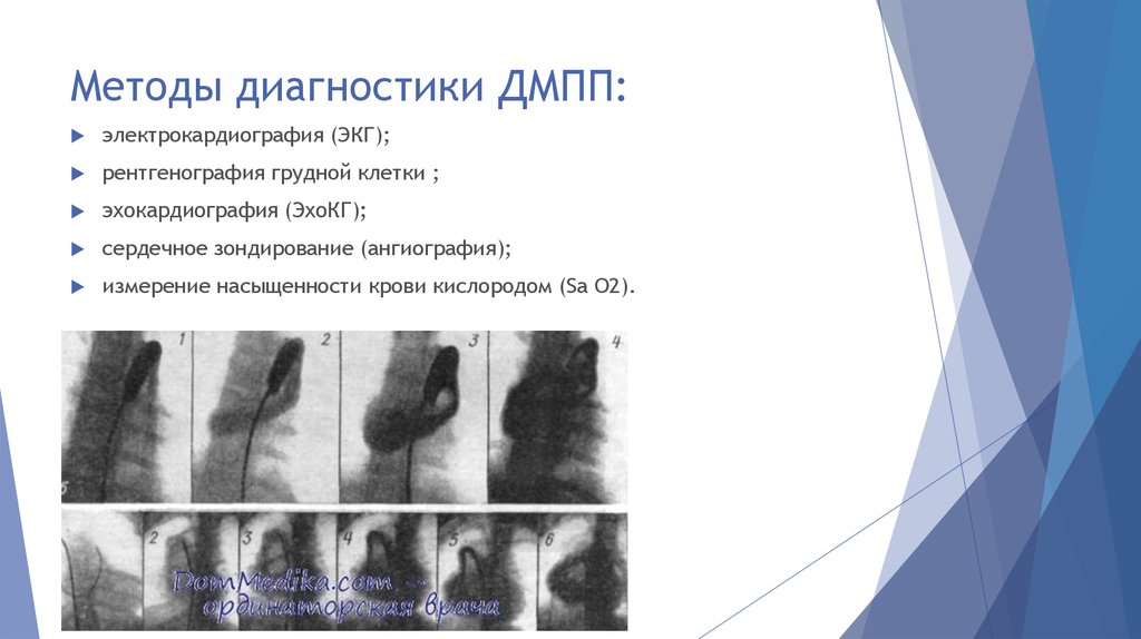 Признаки дефекта. Дефект межжелудочковой перегородки на рентгенограмме. Дефект межпредсердной перегородки рентгенограмма. Рентген при дефекте межжелудочковой перегородки. Дефект межпредсердной перегородки рентген.