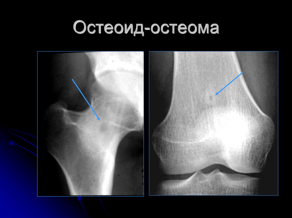 Остеоид остеома бедренной кости