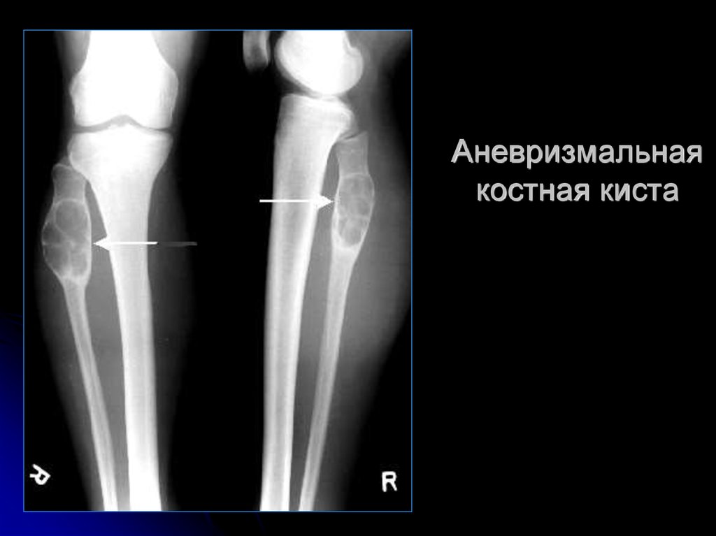 Операция кисты кости. Аневризматическая киста большеберцовой кости. Костная киста большеберцовой кости рентген. Аневризматическая костная киста большеберцовой кости. Солитарная костная киста рентген.