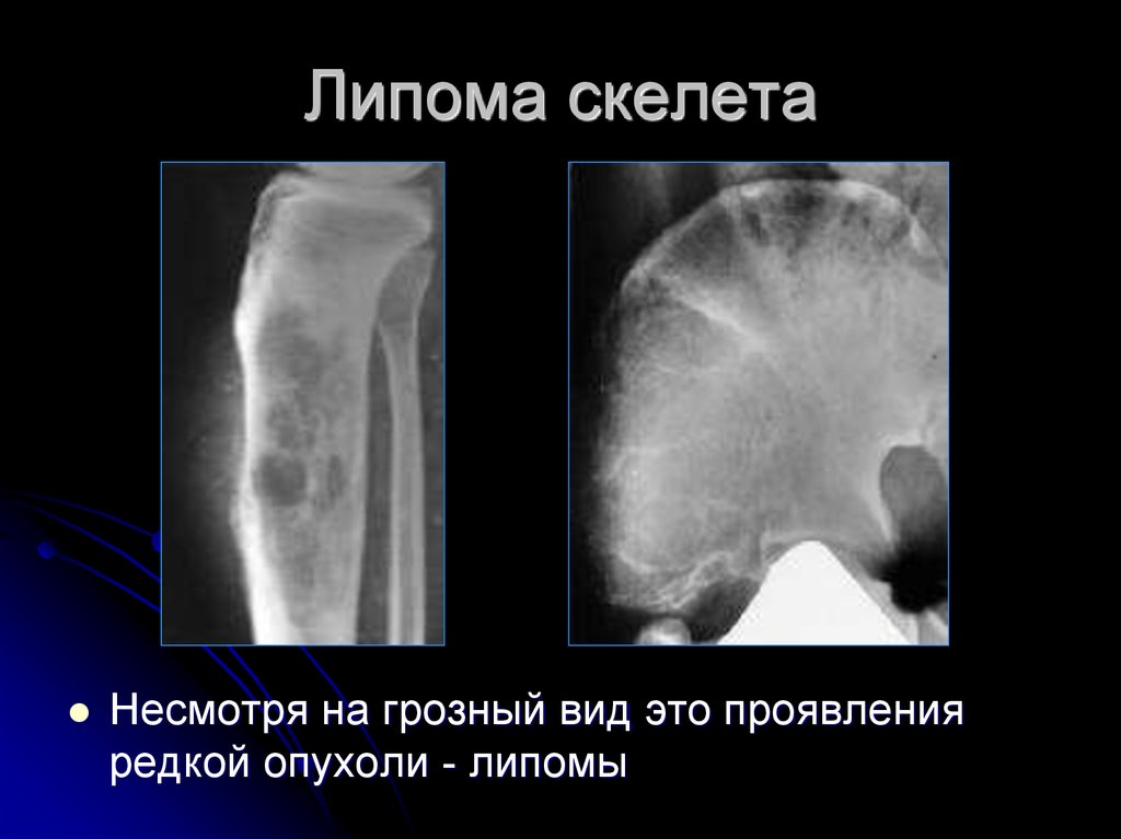 Липома в легких. Рентгенодиагностика опухолей. Опухоли опорно-двигательного аппарата презентация.