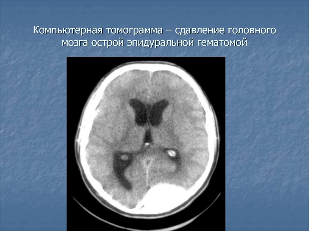 Сдавление головного мозга гематомой