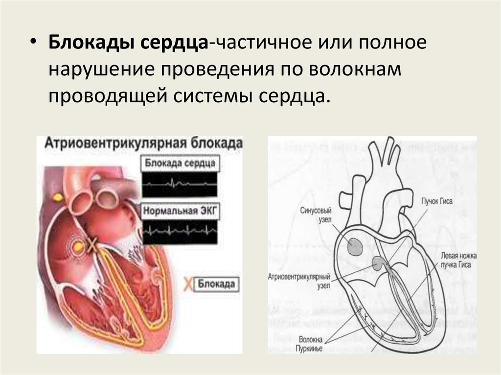 Блокада сердца опасно для жизни