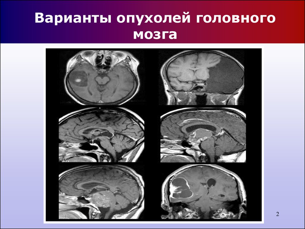 Оттек головного мозга. Объемное образование головного мозга. Новообразование в головном мозге. Злокачественное новообразование головного мозга.