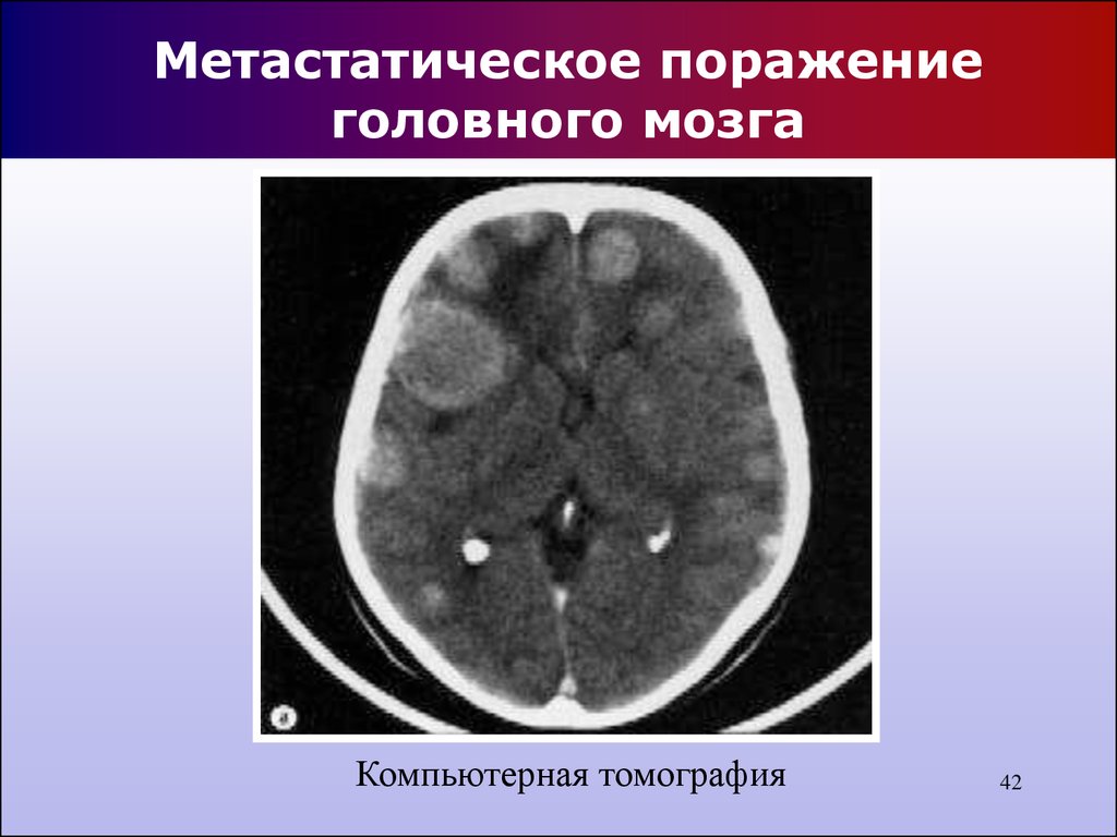 Врожденные опухоли