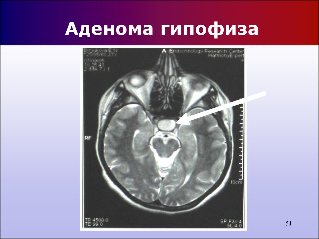 Микроаденома гипофиза. Эндоселлярные аденомы гипофиза. Соматотропная аденома гипофиза. Опухоль аденома гипофиза. Аденома гипофиза кортикотропинома.