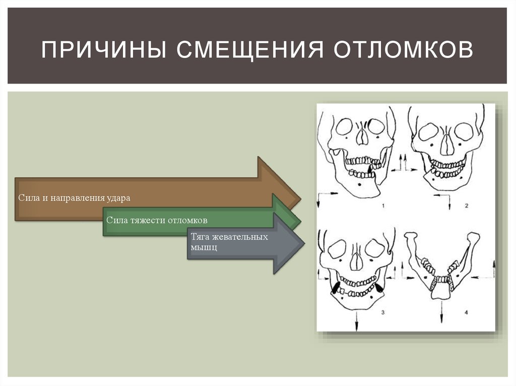 Перелом мыщелкового отростка нижней челюсти. Перелом нижней челюсти со смещением отломков. Смещение отломков нижней челюсти. Механизм смещения отломков челюстей. Механизм смещения отломков нижней челюсти.