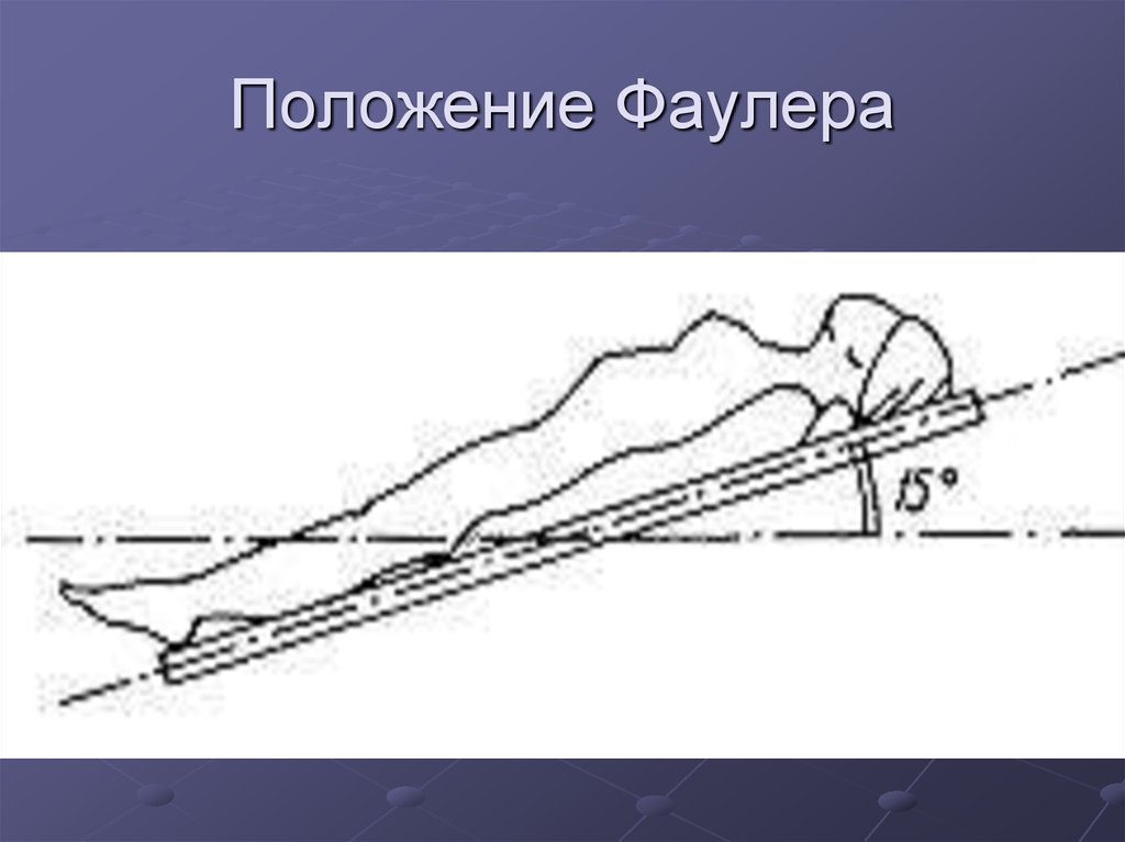 Положение тренделенбурга. Положение Фаулера. Позиция Фаулера. Положение Фаулера это положение.