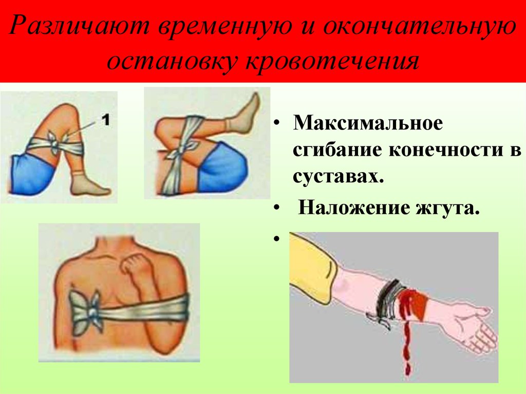 При кровотечении из вены конечности. Наложение жгута при кровотечениях. Наложение жгута и максимальное сгибание конечности в суставе. Наложение артериального жгута. Алгоритм наложения жгута на конечность.