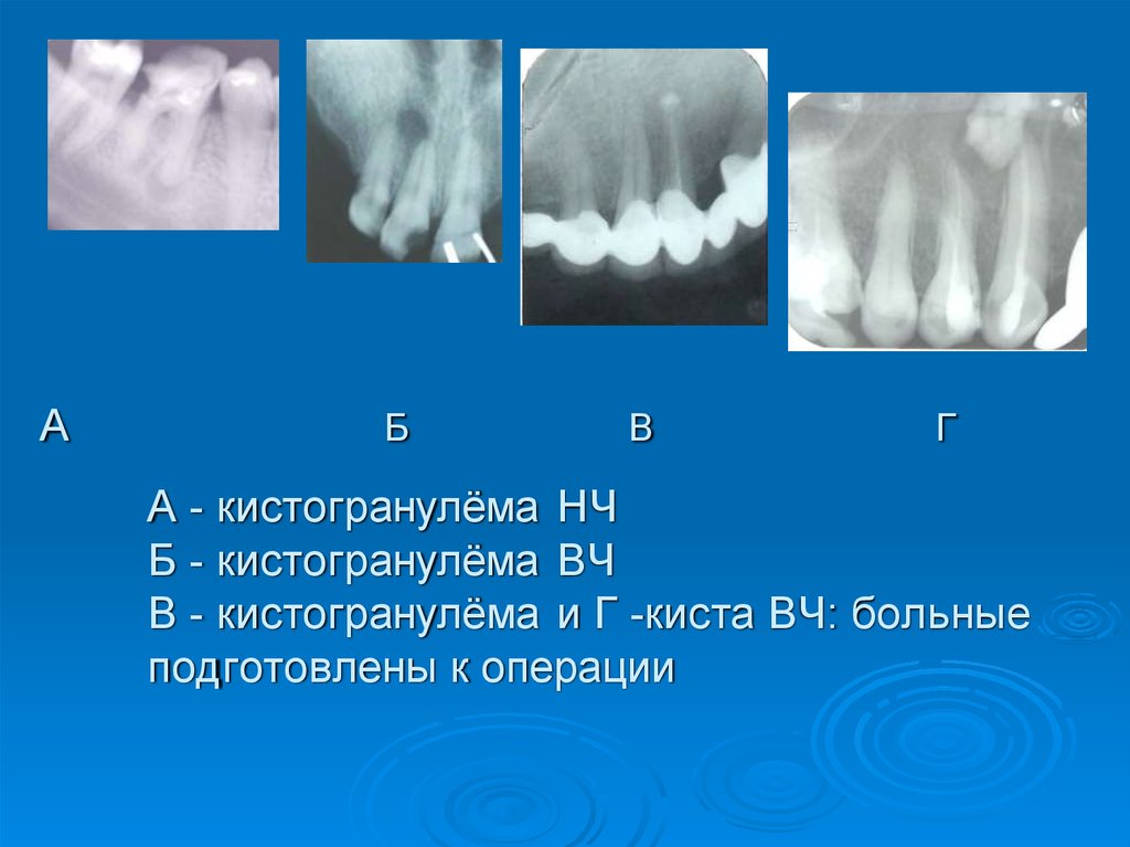 Неодонтогенные кисты презентация