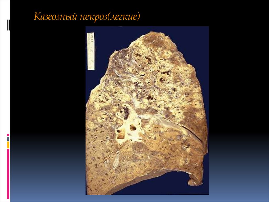 Казеоз это. Казеозная пневмония патологическая анатомия. Казеозная пневмония макропрепарат. Казеозный туберкулез патанатомия. Творожистый некроз туберкулез.