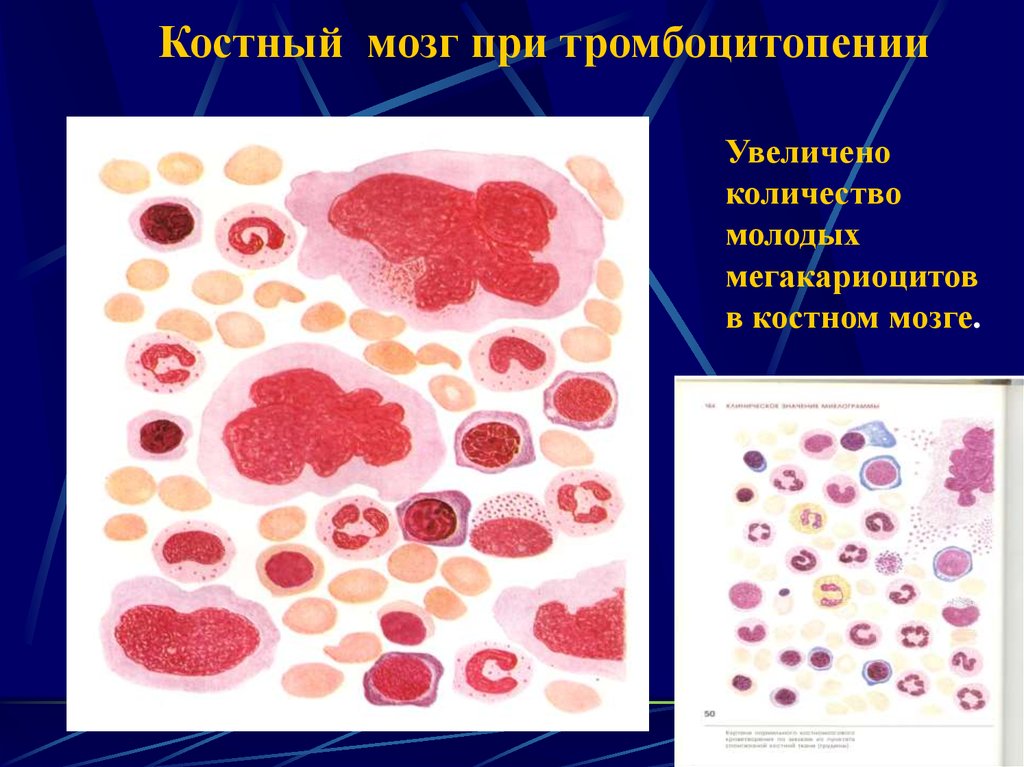 Сколько костного мозга. Мегакариоциты в костном мозге. Мегакариоциты красного костного мозга. Мегакариоциты в селезенке. Мегакариоциты увеличены в костном мозге.