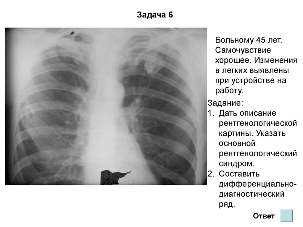 Изменения в легких. Возрастные изменения легких. Флюорография возрастные изменения в легких что это такое. Возрастные изменения легких на рентгенограмме.