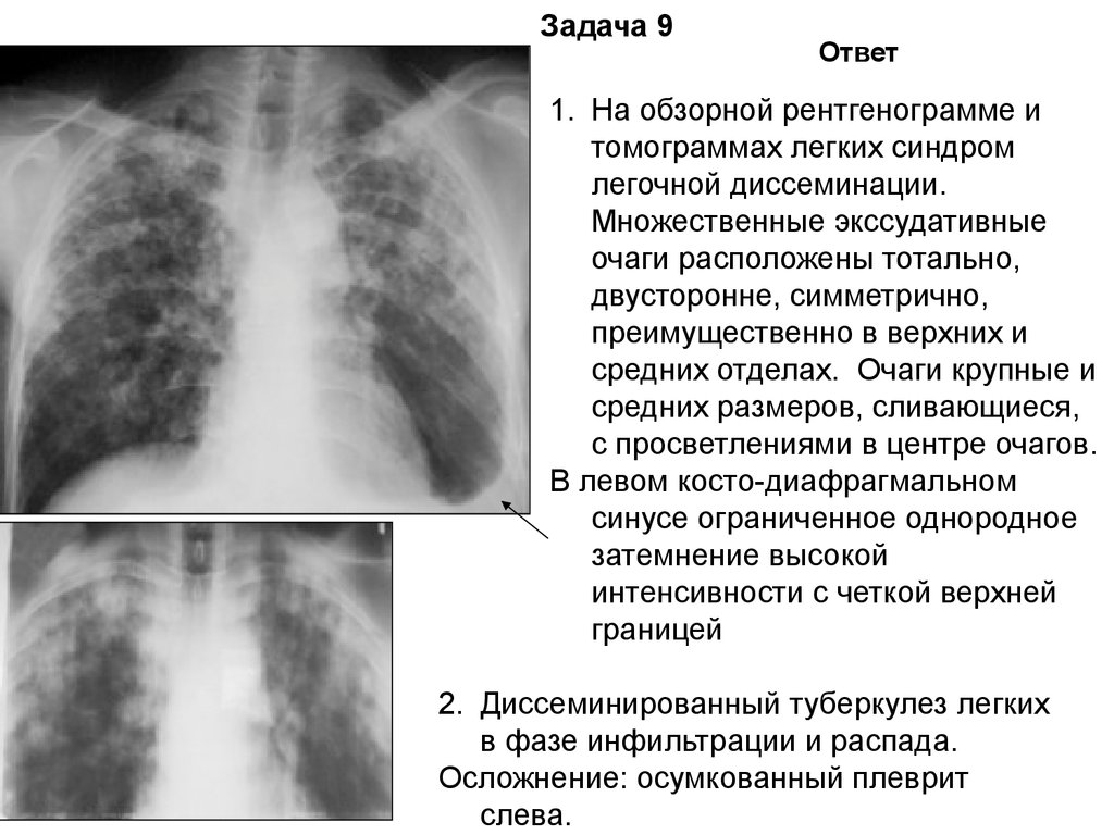 Средняя интенсивность очага