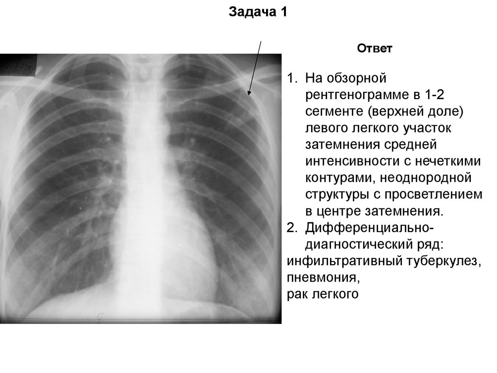 Затемнение в легких