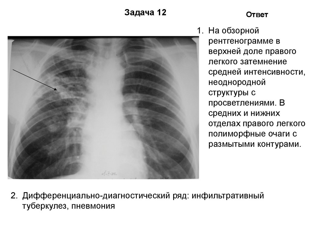 Тени средней интенсивности в легком