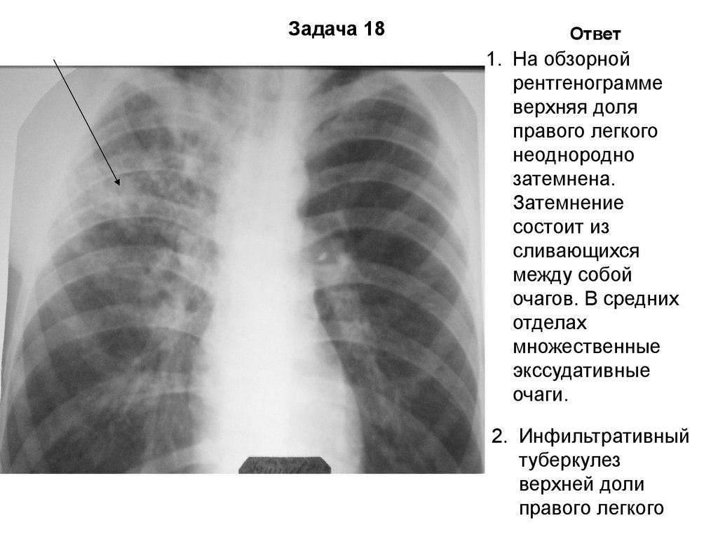 Очаговых изменений правого легкого. Инфильтративный туберкулез рентген. Инфильтративный туберкулез верхней доли рентген. Диссеминированный туберкулёз лёгких рентген. Инфильтративный туберкулез верхней доли правого легкого.