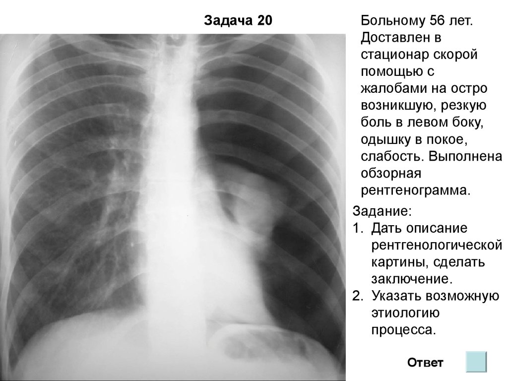 Спавшее легкое. Спонтанный пневмоторакс туберкулез. Рентгеносемиотика спонтанный пневмоторакс. Пневмоторакс рентген снимки. Пневмоторакс и гидроторакс на рентгене.