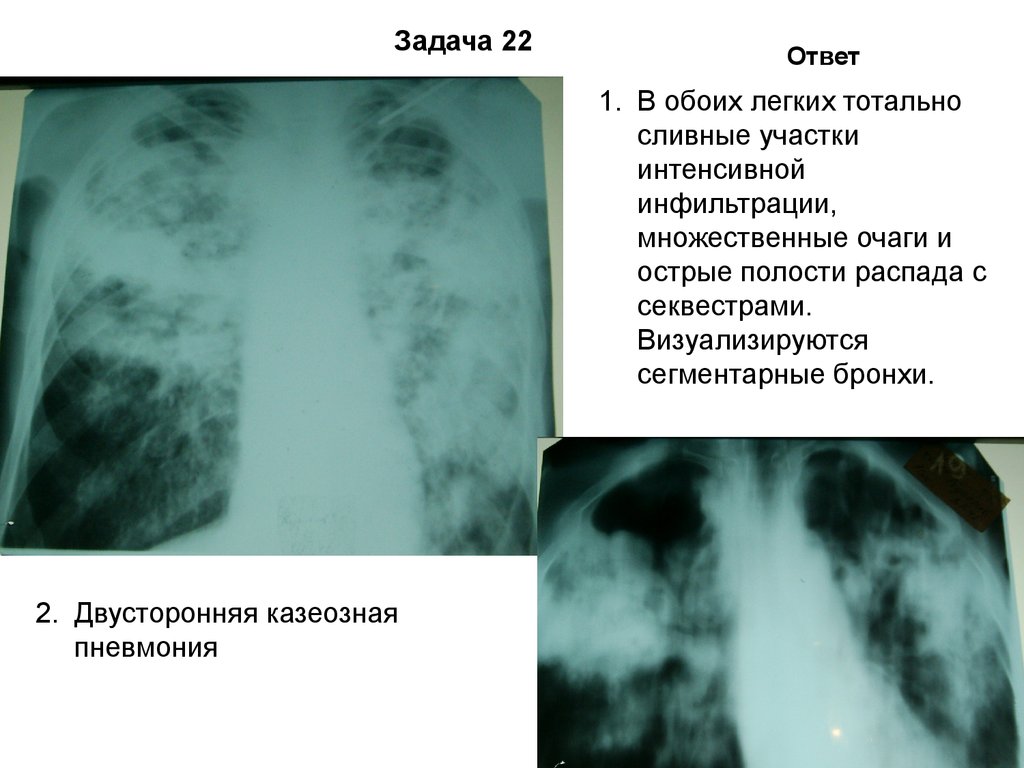 Обоих легких. Казеозная пневмония в фазе распада. Двухсторонняя казеозная пневмония. Двусторонняя казеозная пневмония рентген. Двусторонняя казеозная пневмония в фазе распада.