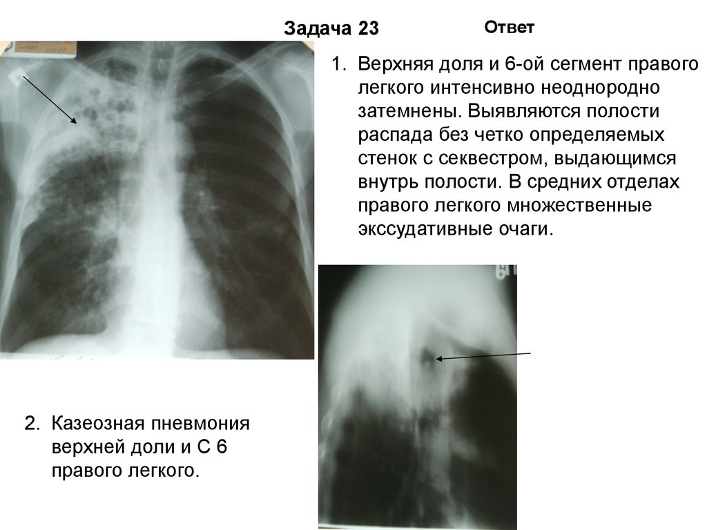 Пневмония верхней доли легкого. Пневмония верхней доли левого легкого. Полисегментарная пневмония s1-s2. Доли правого легкого. Пневмония верхней доли.