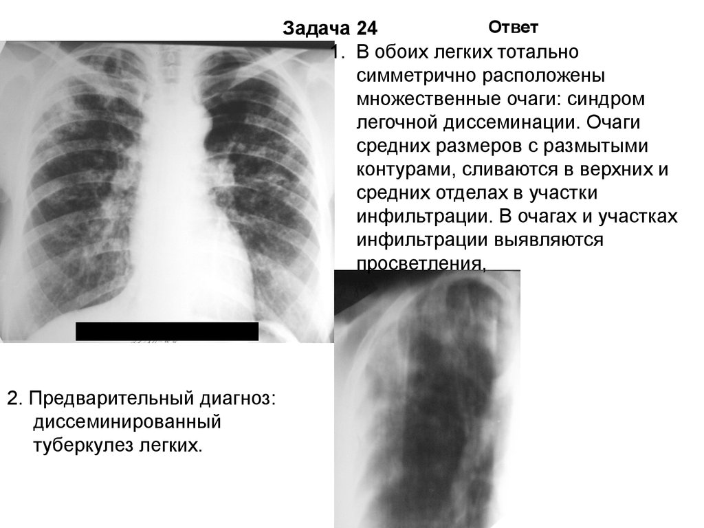 Очаги в легких с четкими контурами