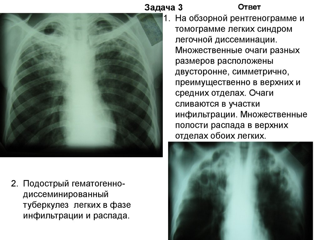 Диссеминированный туберкулез фаза инфильтрации. Диссеминированный туберкулез легких описание рентгенограммы. Описание рентгенограммы диссеминированного туберкулеза. Подострый диссиминированный туберкулёз рентген. Описание диссеминированного туберкулеза на рентгене.