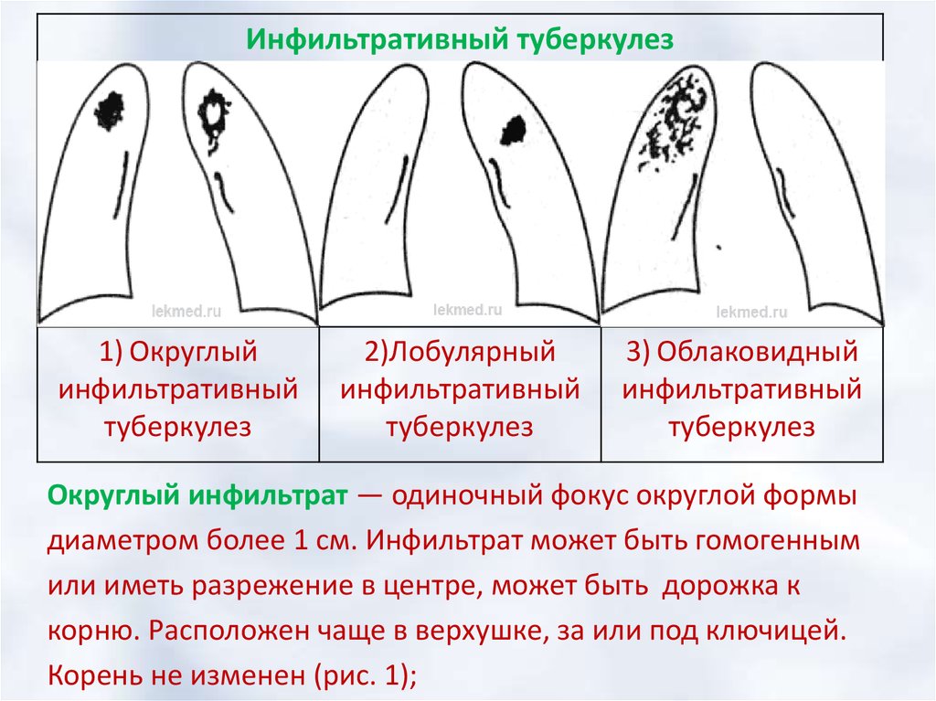 Лечение инфильтративного туберкулеза. Круглый инфильтративный туберкулез. Формы инфильтративного туберкулеза. Инфильтративный туберкулез округлый инфильтрат. Инфильтративный туберкулез округлой формы.