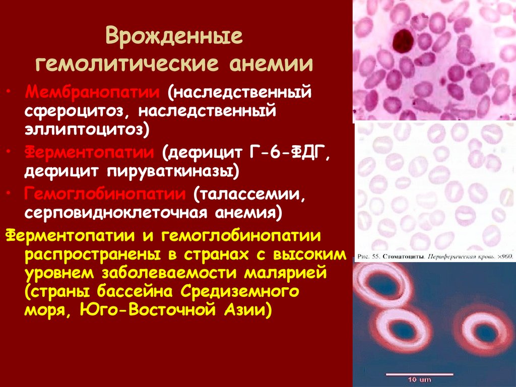 Анемия гемолитического типа. Гемоглобинопатии гемолитическая анемия. Серповидноклеточная анемия морфология. Серповидноклеточная анемия у животных. Гемолитическая анемия гипохромия.
