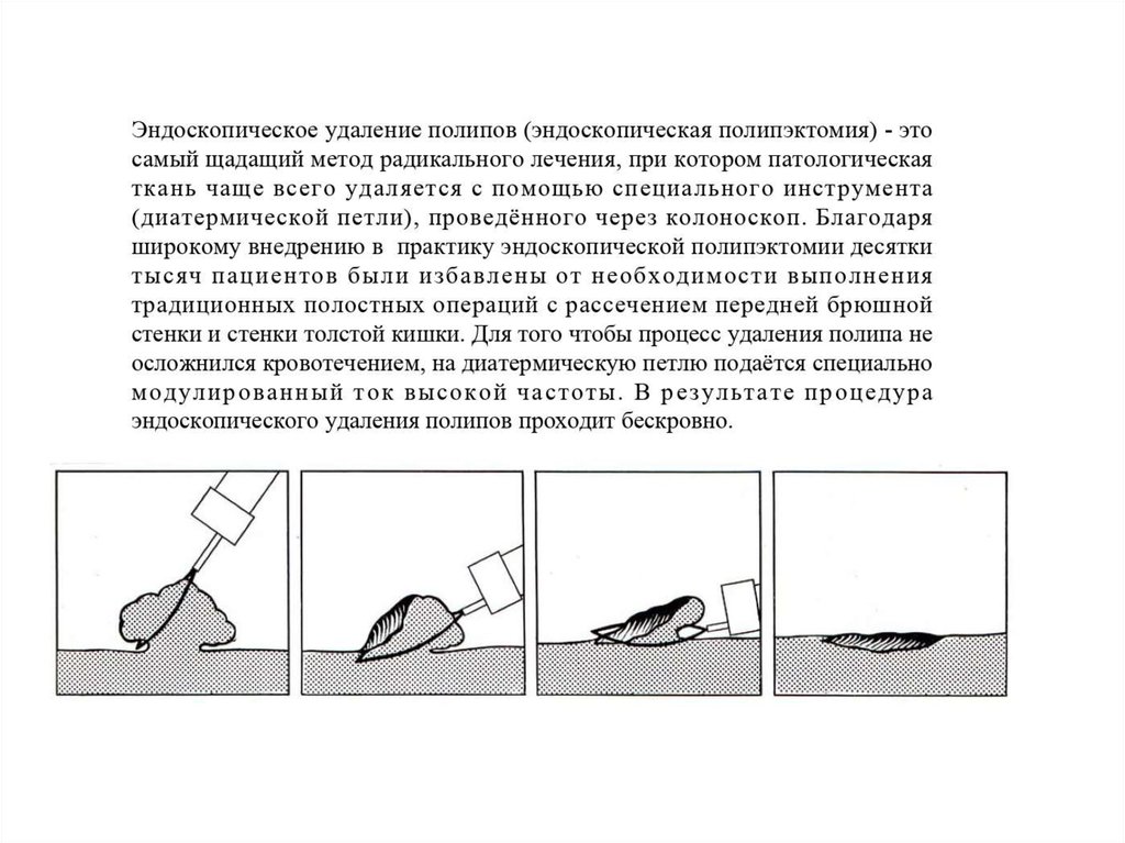 Дюфастон после удаления полипа