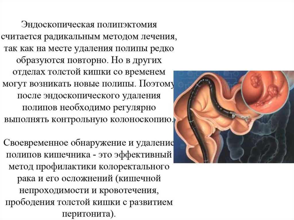Эндоскопическое лечение полипов прямой кишки - презентация онлайн